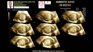 Amniotic Band syndrome 25 weeks [upl. by Yrogerg616]