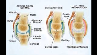 Artritis Reumatoide Cuidado De Las Articulaciones [upl. by Nohsad989]