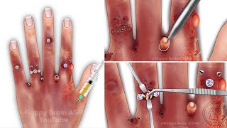 ASMR Hand Piercing Hands Infections Worm and Maggot Removal  Treatment and Deep Cleaning Animation [upl. by Novyert]