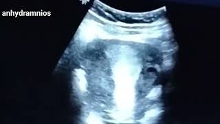 Ultrasound of a live baby with anhydramnios [upl. by Abihsot621]