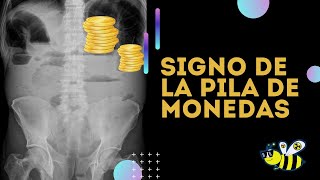 Signo de la pila de monedas en radiografía Que puede significar [upl. by Airotnes]