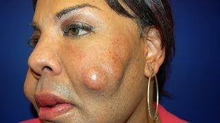 Cosmetic Surgery Disaster Woman Dubbed Cement Face Given New Lease Of Life [upl. by Ahselef]