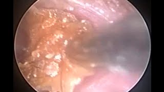 Best method for ear cleaning  Otoendoscopic microsuction earwax removal [upl. by Fons]