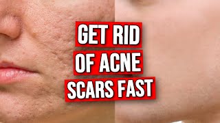 3 DOs amp DONTS To Get Rid of Acne Scars FAST [upl. by Ko340]