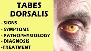 Tabes Dorsalis  Neurosyphilis Tabes Dorsalis  Tabes Dorsalis Signs amp Symptoms medicine [upl. by Hahcim]