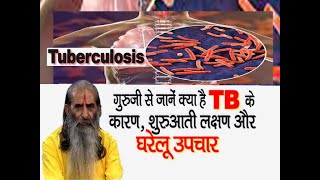 टीबी तपेदिक के कारण लक्षण और इलाज़  Tuberculosis causes symptoms treatment amp prevention [upl. by Mosier308]