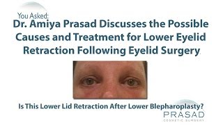 The Causes of Pulled Down Eyelids After Surgery from Temporary to Needing an Oculofacial Specialist [upl. by Inalan]