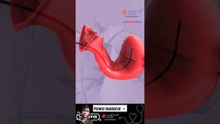 Brachytherapy cervical cancer shorts knowledge animation [upl. by Lledner241]