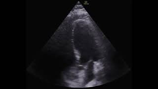 Regional Wall Motion Abnormality POCUS [upl. by Enawd90]