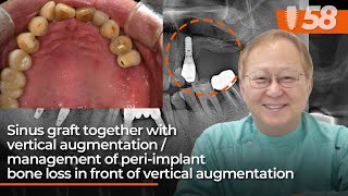 Sinus graft amp vertical augmentation managing periimplant bone loss in front of vertical augment [upl. by Oleusnoc]