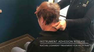 Nuchal Ligament treatment for neck pain [upl. by Gaut]