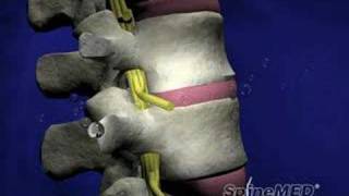 Spinal Decompression [upl. by Arocal535]