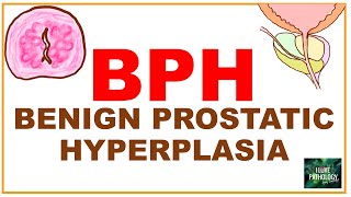 Benign Prostatic Hyperplasia  BPH etiopathogenssis Pathology amp clinical features [upl. by Anivram]