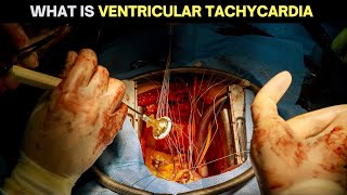 Understanding Ventricular Tachycardia Causes Symptoms and Treatments [upl. by Lynette865]