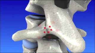 Degenerative Disc Disease  Spine Degeneration [upl. by Arej550]