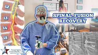 Spinal Fusion Recovery EXPECTATIONS 🧗‍♀️🏨🏌️🏆 [upl. by Cassius]