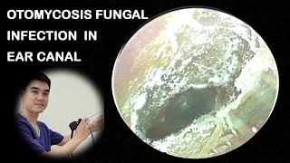 OTOMYCOSIS FUNGAL INFECTION IN EAR CANAL amp EAR WAX REMOVAL HATA5 [upl. by Nylyak559]