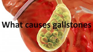 What causes gallstones and the thyroid hormone connection [upl. by Ednew]