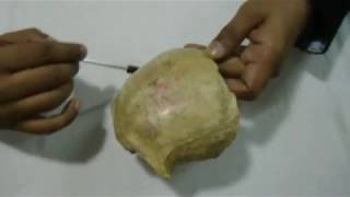 Frontal bone Anatomical position demonstrated by Dr Zobayer [upl. by Acilef]