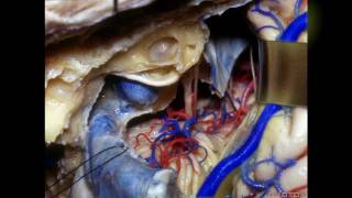 Navigating the Temporal Bone  Part 3 of 3 [upl. by Bocoj]