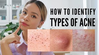 How to treat EVERY type of acne With Pictures [upl. by Ulises]