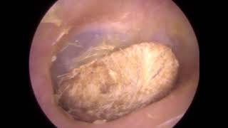 A Compilation of Foreign Body Removals amp Extractions from the Ear Canal by The Wax Whisperer  333 [upl. by Otrebla]