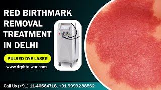 Red Birthmark Removal  Portwine Stain Removal in Delhi India by Pulsed Dye Laser  Dr PK Talwar [upl. by Llenyl]