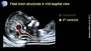 Normal fetal brain anatomy at 1113 weeks  2D scan [upl. by Nayllij243]