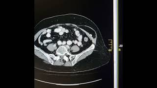 Differences between Spigelian hernia and simple anterior abdominal wall hernia [upl. by Zolly]