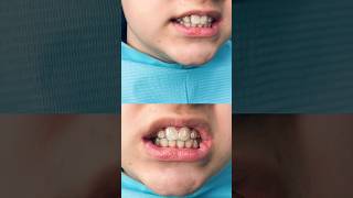 Você sabe o que são os aparelhos invisíveis Invisalign Conheça algumas vantagens destes Alinhadores [upl. by Adnilec129]