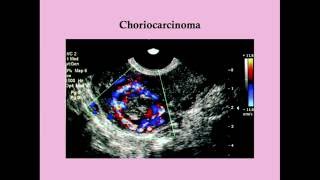 Malignant Gestational Trophoblastic Disease  CRASH Medical Review Series [upl. by Arimahs]