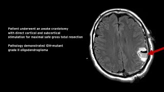 Case Report IDHMutant Grade II Oligodendroglioma [upl. by Llenart]