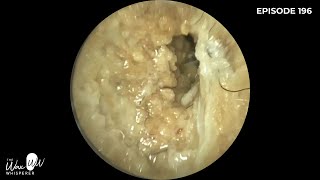 196  Swimming induced Otitis Externa Outer Ear Infection Removal with WAXscope®️ [upl. by Enilrem]