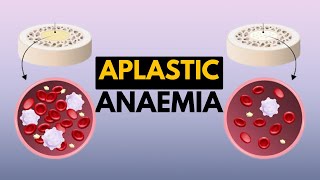 Aplastic Anaemia Causes Signs and Symptoms Diagnosis and Treatment [upl. by Edac682]