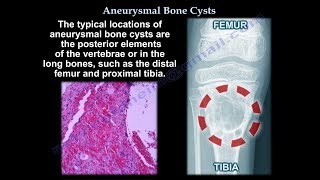 Aneurysmal Bone Cyst  Everything You Need To Know  Dr Nabil Ebraheim [upl. by Angadreme]