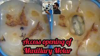 Access opening of Maxillary Molar step by step demonstration  rct for beginners  dental lectures [upl. by Anahir]