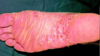 Types of Psoriasis  An Overview [upl. by Oinimreh]