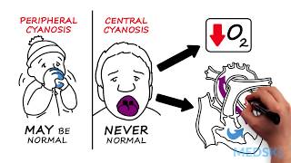 Hypoxia and Cyanosis How to react when oxygen levels are low [upl. by Mountford]