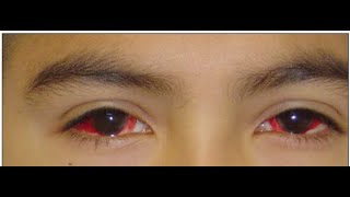 Pediatric Ophthalmology Lecture Preview [upl. by Ennadroj84]