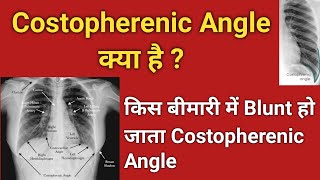 costophrenic angle  How to Identify costophrenic angle on x ray chest [upl. by Aerdnad860]