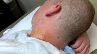 Cyst treatment 2016  Remover Cyst from Germans skin  Acne exploision [upl. by Virginie]