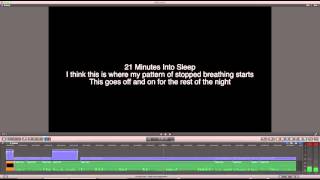 The Dreaded Sound of Sleep Apnea  Extreme Loud Snoring [upl. by Eboh]