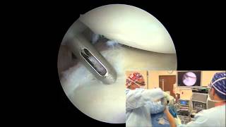 Arthroscopic Posterior Labral Repair  Randy S Schwartzberg MD [upl. by Bing]