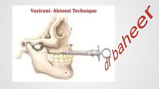 Akinosi technique  closed mouth injection [upl. by Twum97]