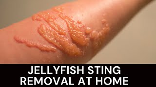 Jellyfish Sting Removal How  JellyFish Sting Removal Remedies [upl. by Brnaby]