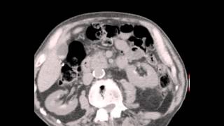 CT Abdomen Pelvis Renal Cysts Seminal Vesicle hemorrhage Discussion by Radiologist [upl. by Wolpert]