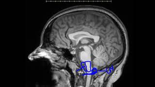 Midline Cisterns and Spaces of Brain MRI [upl. by Gen]