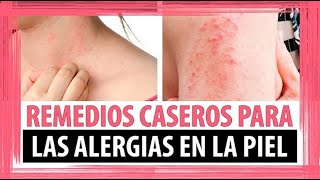 Los 3 tipos de ALERGIAS EN LA PIEL más comunes ⭐ ¿ Se cura la Dermatitis  ⭐ SmartSalus [upl. by Jotham]