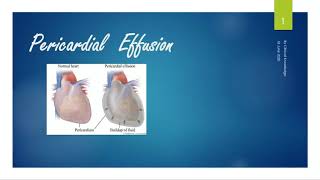 Pericardial Effusion  Definition Causes Signs and Symptoms Investigation and Management [upl. by Talanian941]