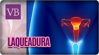 Laqueadura Cirurgia e Reversão  Você Bonita 300118 [upl. by Zeugirdor931]